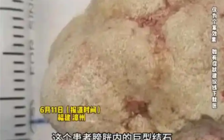 男子爱吃烧烤海鲜长出巨型结石 医生：建议每天喝3升水 ！