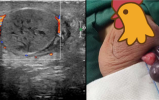 男孩摔下秋千睾丸扭转540度 超过6小时抢救黄金期无奈遭切除 ！