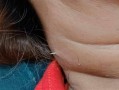泰国女子吃鱼时被鱼刺扎穿脖子：医生直呼活久见 ！