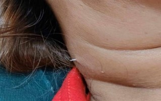 泰国女子吃鱼时被鱼刺扎穿脖子：医生直呼活久见 ！