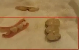 老人术后体内发现5颗牙和牙套：直到离世肺部的1颗假牙始终无法取出 ！