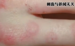 女孩以为手上长冻疮却确诊红斑狼疮：擅自减药、停药可能带来严重后果 ！