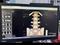 小伙学冲浪闪了腰致截瘫：确诊罕见病“冲浪者脊髓病” !