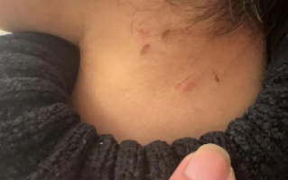 家长称孩子遭老师虐待 身上都是抠痕 ！警方：该保育员已经被控制 ！