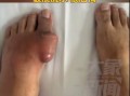 40岁男子因长期喝碳酸饮料 脚上长6cm痛风石 5年无法正常穿鞋 !