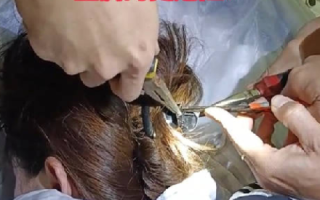 女子出车祸鲨鱼夹插入后脑勺 ！网友：看起来都疼！ 