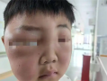 男孩一觉醒来脸肿成“发面馒头”：被蚊虫叮的面目全非 ！
