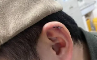 小伙理发时耳朵被剪缝六针：事发一周双方还未就赔偿金额达成一致 ！