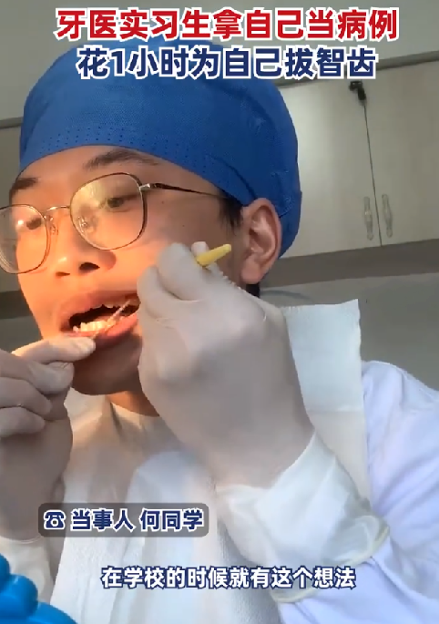 牙医实习生花1小时为自己拔智齿 ！网友调侃“是个狠人！”-第1张图片