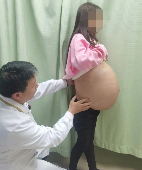 女子腹内长出重46斤巨大脂肪肉瘤：是目前重庆已知的最重脂肪肉瘤 ！-第1张图片