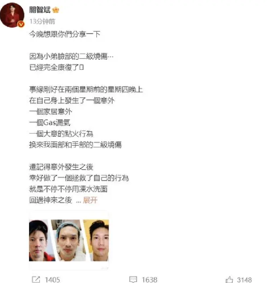 港星关智斌面部手部二级烧伤：遭遇煤气泄露所致，头发眉毛烧焦  ！-第1张图片