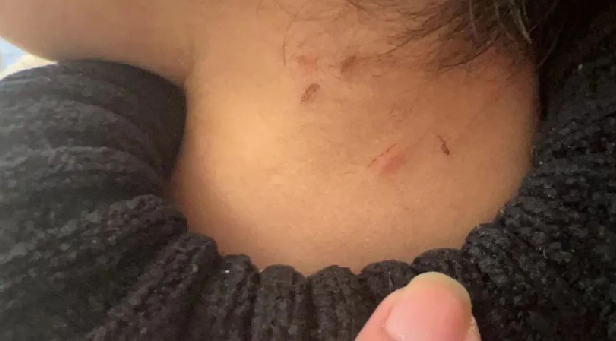 家长称孩子遭老师虐待 身上都是抠痕 ！警方：该保育员已经被控制 ！-第1张图片