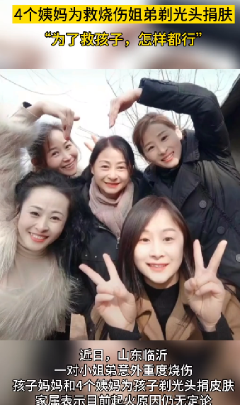 姐弟烧伤：四位姨妈剃光头捐头皮 ！-第1张图片